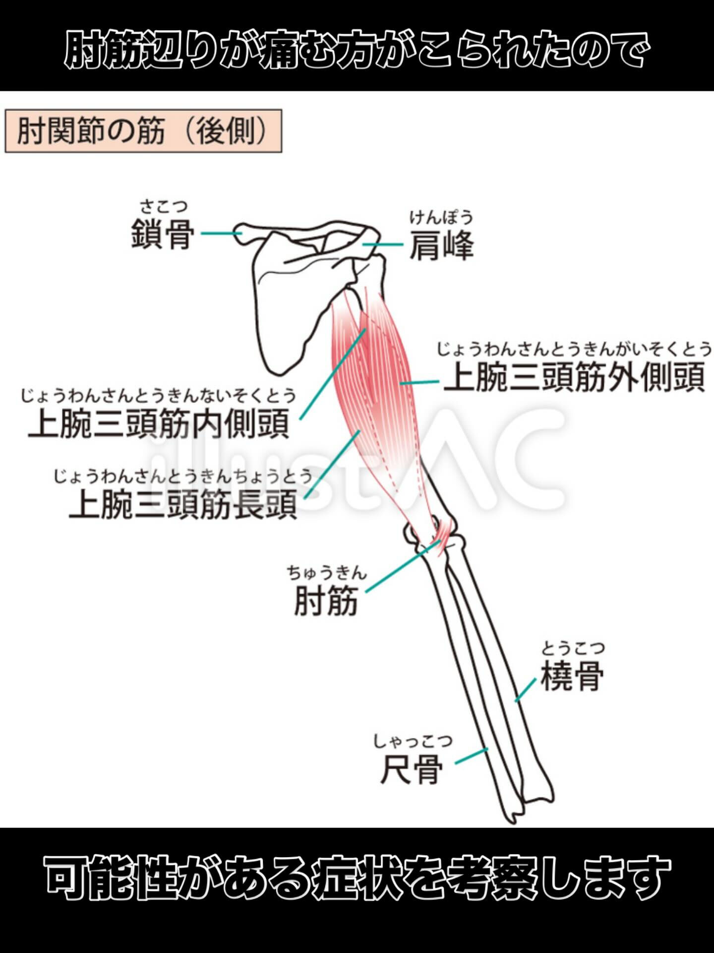 上腕 三 頭 筋 痛み